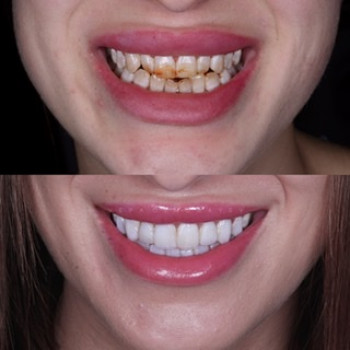 Художня реставрація, фото - стоматолог Вепа Джумаев