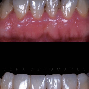 Художня реставрація, фото - стоматолог Вепа Джумаев