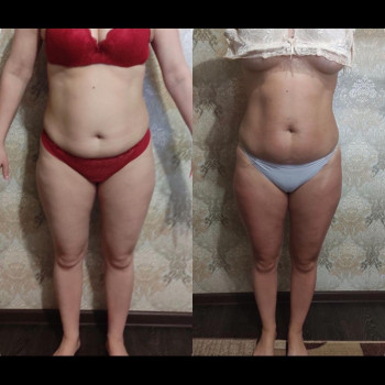 Массаж СТАРВАК для тела антицеллюлитный/моделирующий
                    Косметолог Елена Одесса