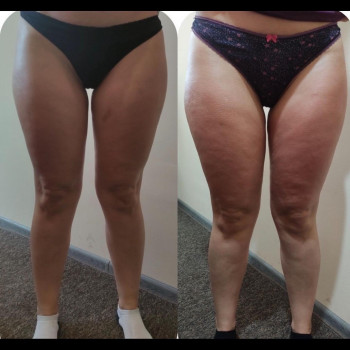 Массаж СТАРВАК для тела антицеллюлитный/моделирующий
                    Косметолог Елена Одесса