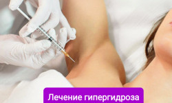 Лечение гипергидроза (Botox) Косметолог-инъекционист Наталья Киев