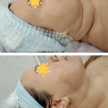 Испанский массаж лица, шеи и декольте + сыворотка + альгинатная маска
                    Косметолог-естетист Наталья Дніпро