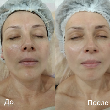 Испанский массаж лица, шеи и декольте + сыворотка + альгинатная маска
                    Косметолог-естетист Наталья Дніпро