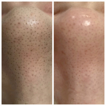 Ультразвуковая чистка лица
                    Косметолог-эстетист Наталья Днепр