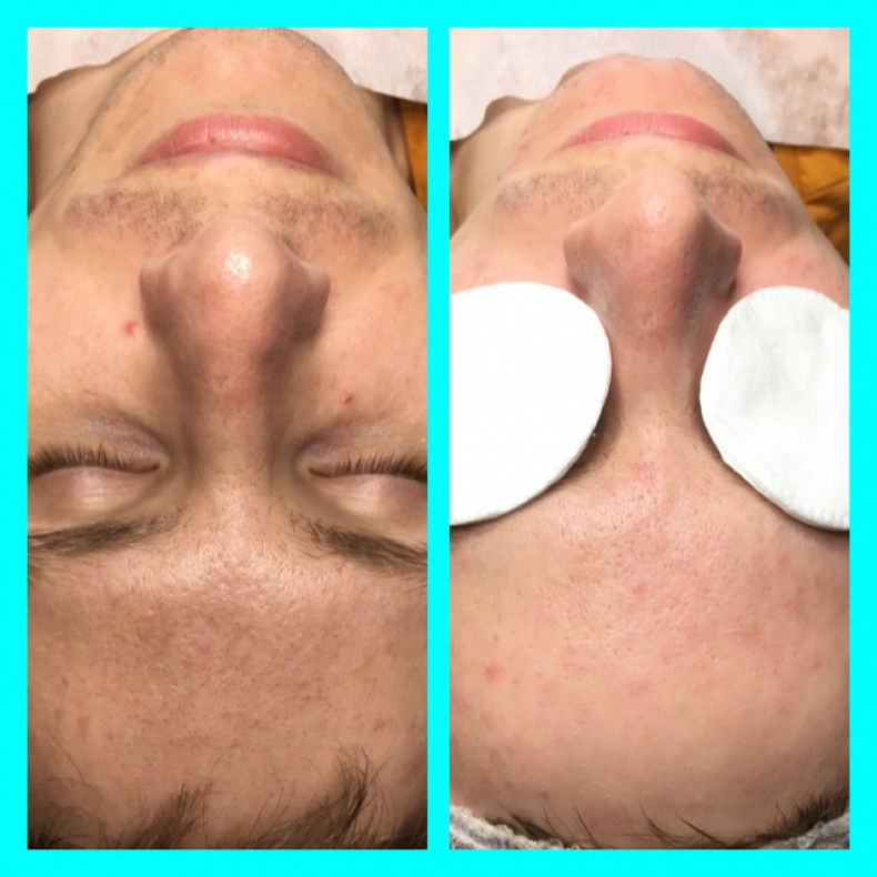 Чистка лица до и после.
 #чисткаобличчя, фото - Мастер по пирсингу Татьяна Ананьева