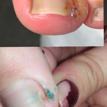 врослий ніготь, грибок нігтя