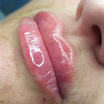 Відновлення природного об'єму