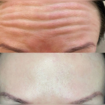 Ботулінотерапія