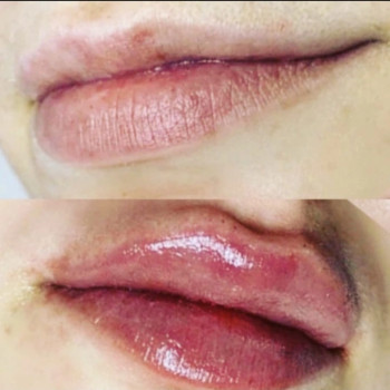 Увеличение губ филлером 1мл.