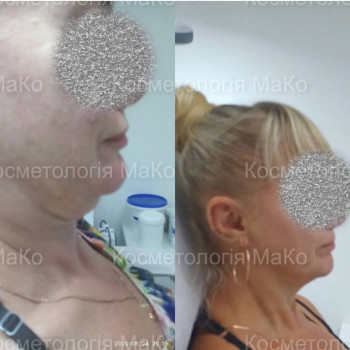 Рф-ліфтинг
                    Косметологічний центр МаКо Київ