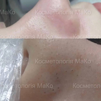 Мануальна/комбінована чистка обличчя + терапевтичний пілінг
                    Косметологический центр МаКо Киев