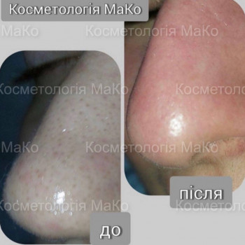 Мануальна/комбінована чистка обличчя + терапевтичний пілінг
                    Косметологический центр МаКо Киев