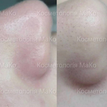 Мануальна/комбінована чистка обличчя + терапевтичний пілінг
                    Косметологический центр МаКо Киев