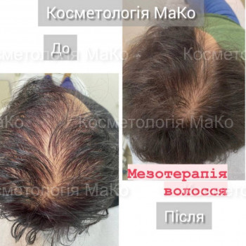 Мезотерапія волосистої частини голови
                    Косметологический центр МаКо Киев