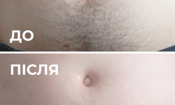 Депиляция воском, Шугаринг Мастер депиляции Яна Киев