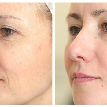 Карбоксітерапія косметологія EVC