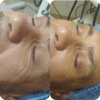 Микротоки лица
                    Косметолог-естетист Анна Одеса