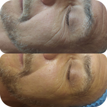 Микротоки лица
                    Косметолог-естетист Анна Одеса