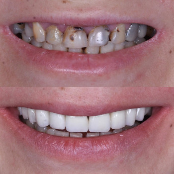 Керамічні коронки, фото - стоматолог Вепа Джумаев