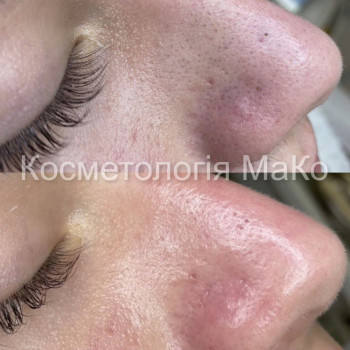 Мануальна/комбінована чистка обличчя + терапевтичний пілінг
                    Косметологический центр МаКо Киев