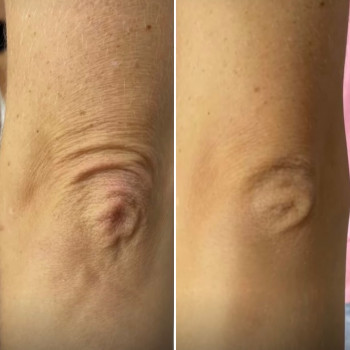 Векторний ліфтинг обличчя, Radiesse
                    Косметолог-инъекционист Наталия Киев