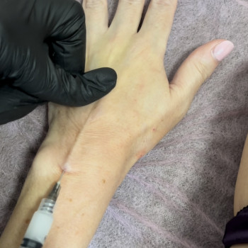 Векторний ліфтинг обличчя, Radiesse
                    Косметолог-инъекционист Наталия Киев