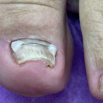 Встановлення титанової нитки (корекція врослого нігтя)
                    Центры подологии Calutte Харьков