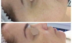 Вакуумна чистка обличчя Hydrafacial Салон красоты Bomond Луцк