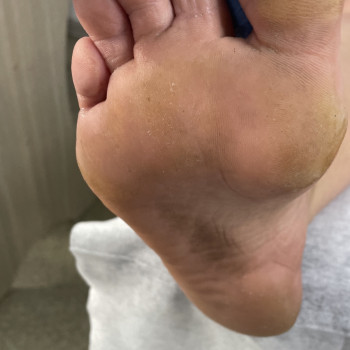 До процедури. Пацієнтка звернулася впарше.