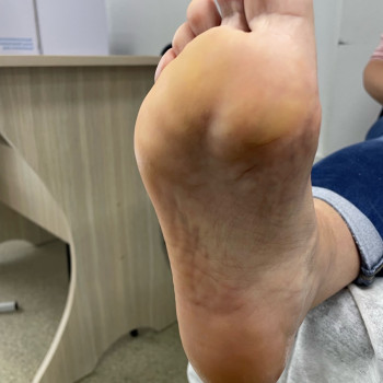 Після процедури.