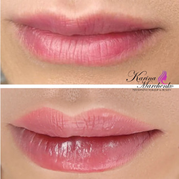 Збільшення губ філлером гіалуронової кислоти.