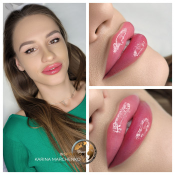 Збільшення губ філером гіалуронової кислоти, 1 мл для природнього ефекту