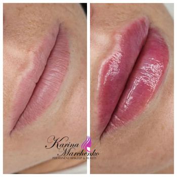 Збільшення губ філером гіалуронової кислоти, 1 мл для природнього ефекту