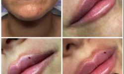 Увеличение и коррекция формы губ Косметолог-инъекционист Ольга Киев