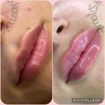 Увеличение и коррекция формы губ
                    Косметолог-инъекционист Ольга Киев