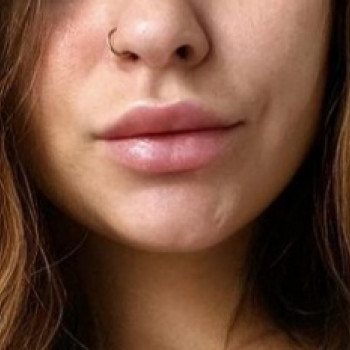 Через три місяці після заживлення. 
1 мл.