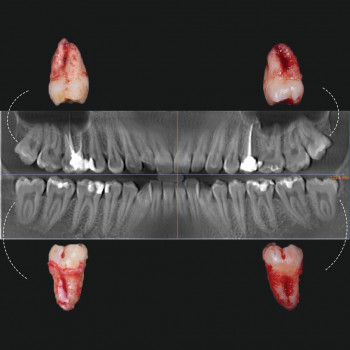 Видалення, фото - стоматолог Вепа Джумаев
