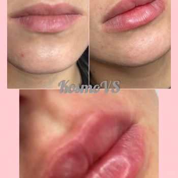 Увеличение и коррекция формы губ
                    Косметолог-инъекционист Ольга Киев