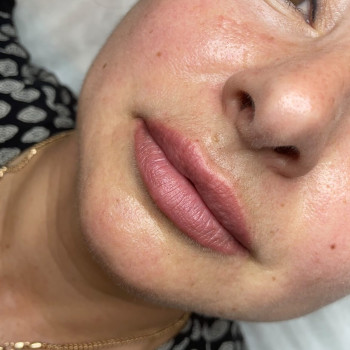 Увеличение и коррекция формы губ
                    Косметолог-инъекционист Ольга Киев