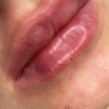 Увеличение и коррекция формы губ
                    Косметолог-инъекционист Ольга Киев