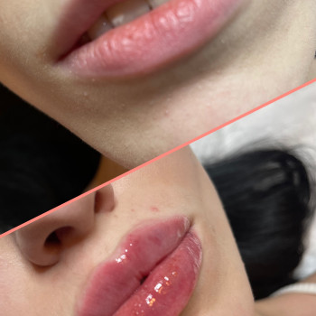 Увеличение и коррекция формы губ
                    Косметолог-инъекционист Ольга Киев