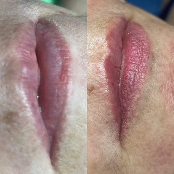 Увеличение и коррекция формы губ
                    Косметолог-инъекционист Ольга Киев