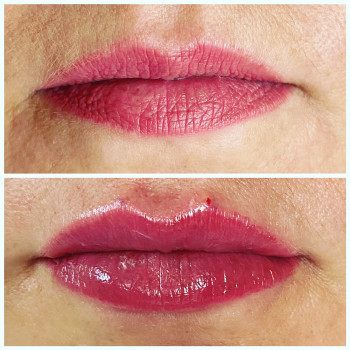 Корекція форми губ, додали об‘єм