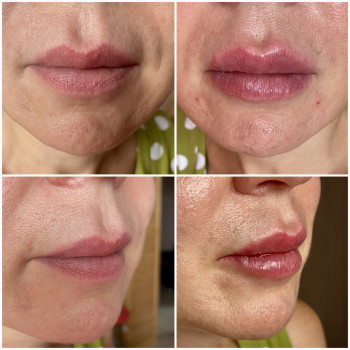 Додали об‘єм, підняли куточки губ