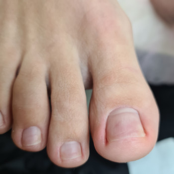 Гигиенический педикюр.