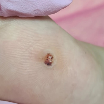 Работа с подошвенными бородавками ( ПВЧ) . Промежуточное фот