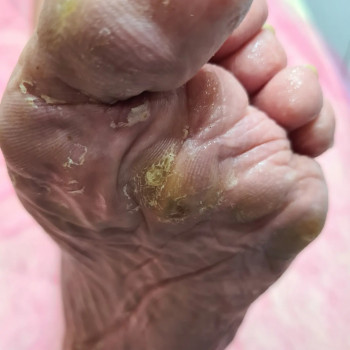 Сложная стопа , до обработки.