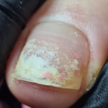 Ожог ногтевой пластины . До зачистки .