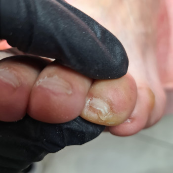 До обработки. Мелкие мозоли и натоптыши.