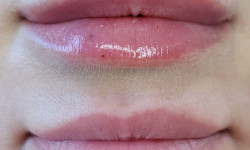 Збільшення губ Косметолог-ін'єкціоніст Татьяна Ірпінь